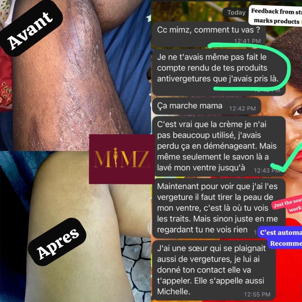 Before and After – Stretch Marks Treatment with MIMZ