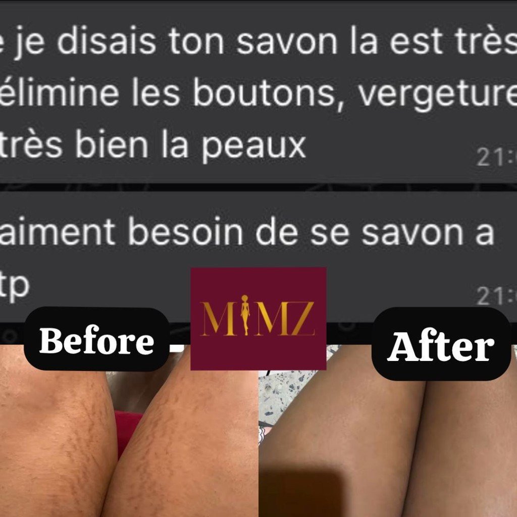 Before and After – Stretch Marks Treatment